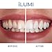 iLUMI at Home Teeth Whitening Kit - Harvard Doctor Approved - 10 Min Non-Sensitive Fast Results, (3) Carbamide Peroxide Gel, (1) Desensitizing Gel (Black)