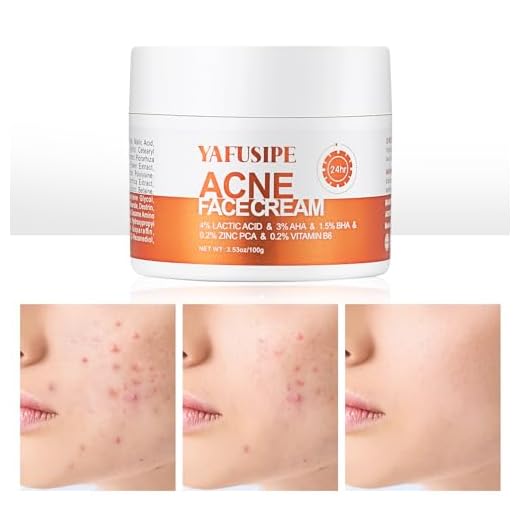 Acne Treatment for Face, Salicylic Acid Acne Cream Back Acne Treatment Cream for Teens & Adults Anti-acne Moisturizer Pimple Cream Butt Acne Clearing Cream, Acne Spot Treatment for Breakouts Blemish