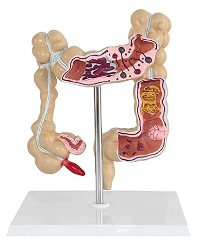 KINOFU Dickdarmmodell Anatomie des Menschlichen Körpers Darmläsion Modell...