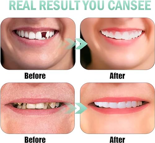 Image of 2 Pairs, Temporarily Adjustable for Men and Women, Regain Confidence Smile, Nature and Comfortable