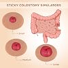 Sticky Colostomy Simulators, Stoma Training Model Set, Multi-Skin Tone Ostomy Care Practice Models for Medical Training and Patient Education- Tan