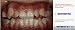1 Kit OrthoForce Self-cure Adhesivo Cemento Dental Ortodoncia Dental Metal Brace