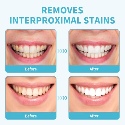 GUTERTOP 60 Pcs Zahnschleifpapier für Zwischenräume, Zahn Schleifpapier, Dental Schleifstreifen, Zähne Polieren Finishing Gloss Contouring Tools Kit Resistent Tiefenreinigung Mundhygiene