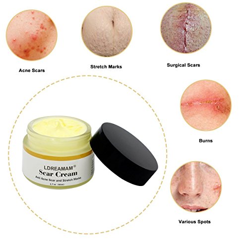 Acne Scar Removal Cream,Scar Cream,Scar Gel,Skin Repair Cream,Treatment for FaceBody Scar,Acne Spots,Stretch Marks, Old and New Scars and Surgical Scars 50ml