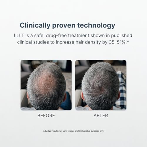 Image of Alpha Hair Growth Laser Cap (136 Lasers) FDA Cleared Laser Hair Growth Device for Men & Women, SMT Laser Technology, Continuous Wave Output, 6-Min Daily Treatment, Drug-Free Hair Regrowth Cap