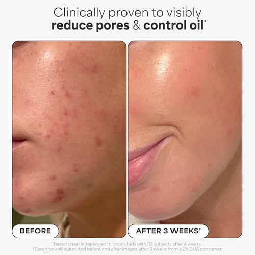 Paula's Choice Skin Perfecting 2% BHA Exfoliante Liquido - Peeling Facial Combate los Puntos Negros, Poros Dilatados y Acne - con Ácido Salicílico - Piel Mixta a Grasa - 30 ml - imagen 5