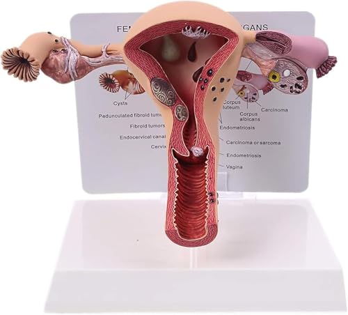 Modèle de pathologie utérine et ovarienne AMITD pour anatomie