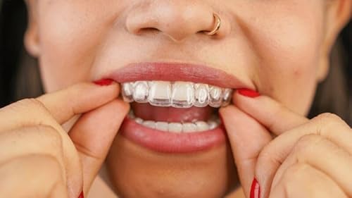 Teeth Aligners and Oral Health Benefits