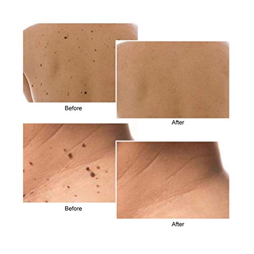 Healifty Toupeira Removedor de Manchas Da Tag Removedor de Manchas Acne Removedor de Toupeira Remove