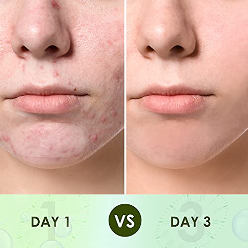 Top 10 Best hydrocolloid acne patch Reviews NecoleBitchie