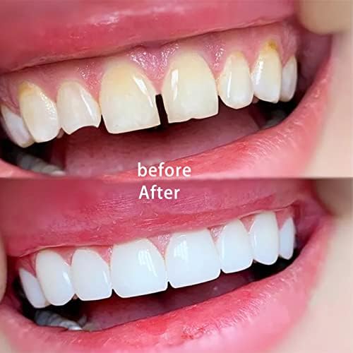 Temporary Tooth Repair Kit Fix Broken Teeth Dental Repair Kit Tooth Filling Replacement False Teeth Adhesive Thermal Fitting Beads with Black Files and Small Scissor for Missing Cracked Chipped Tooth