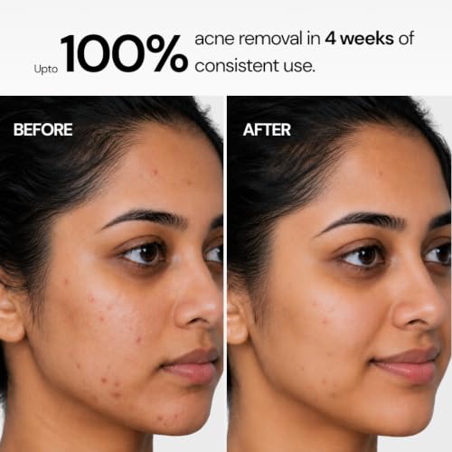 Image of Anti Acne Soap + Sensitive Skin Syndet Bar (Pack of 8) | Sensitive Skin Syndet Bar (Pack of 4) + Anti Acne Soap (Pack of 4)| Clarity Labs