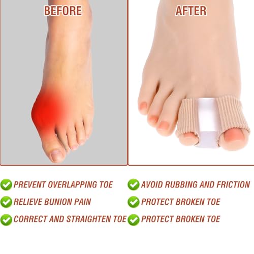 Image of LLOUSSAK 6Pcs Gel Bunion Corrector for Women Big Toe Straightener, Elastic Fabric Toe Spacers Corrector for Women Overlapping Toes, Breathable Hammer Toes Spacers for Men Bunion Foot Pain Relie