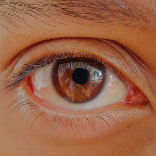 Glaucoma risk, dry eye breakthroughs & Creatine for weight loss