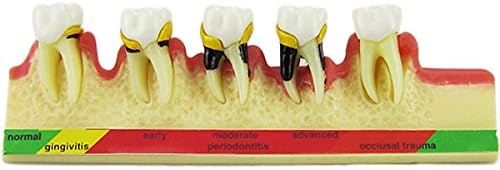Dental Periodontal Disease assort Dientes Dientes Typodont Estudio Modelo de Enseñanza Nuevo