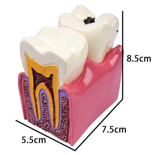 Sarini Zahnmodell, Karies-Vergleichsstudienmodell, Lehrzahnmodell zur Zahnanatomie beim Zahnarzt, geeignet für Zahnärzte, Patienten, Lehrer und Studenten, zahnmedizinische Forschung und Studium
