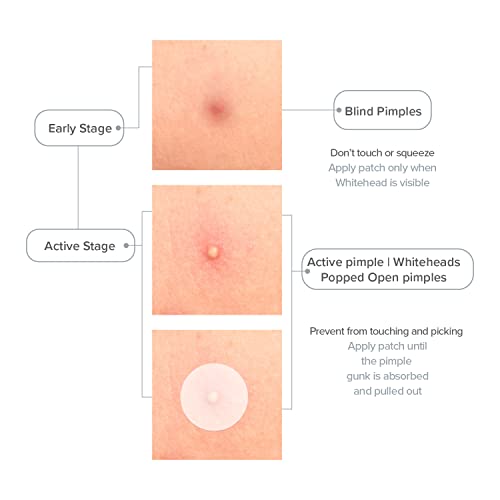 Image of Acne Pimple Patch 57 Units Hydrocolloid Made in Korea 3 Sizes 8mm 10mm 12mm Waterproof Sheet
