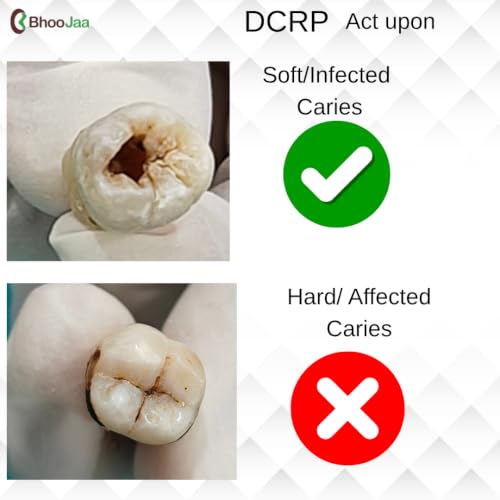 Image of DCRP | Dental Caries Removal Paste for Professional Dental use | Revolutionary Bio-active solution to dissolve soft caries | No Drill, No Pain No anxiety | 3g Pack of 1