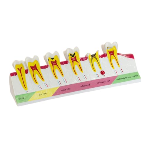 Image of Dental Caries Progression Model,6-Stage Tooth Decay Classification Model for Dental Education,Dental Training,Demonstrations,Oral Care Educatio