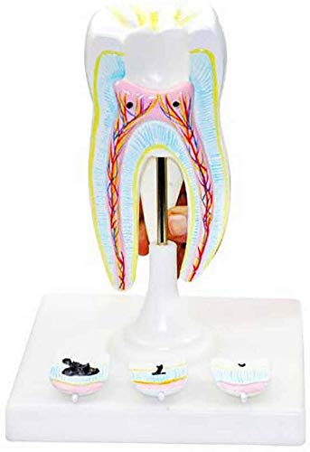 Modelo Dental - Tallada Herramientas De Demostración Modelo De La Caries Dental como Un Modelo De Aprendizaje O Una Herramienta De Investigación