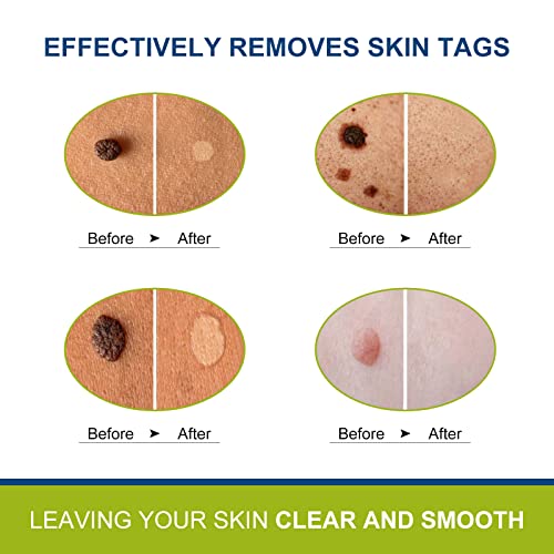 TOPNaturePlus Milia Remover 4PACK, Skin Care Removal, Easy to Apply