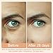 Under Eye Red Light Therapy, Red Light Therapy for Eyes