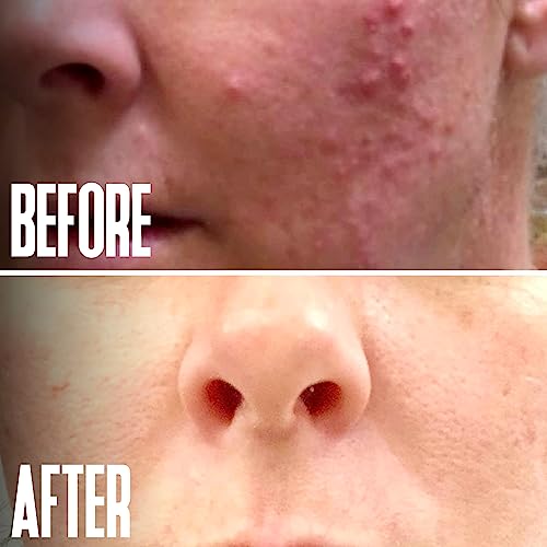 Divine Derriere Glycolic Acid Peel 40% Professional Chemical Peel For Face For Acne Scars thumb #5