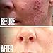 Glycolic Acid Peel 40% Professional Chemical Peel for Face for Acne Scars, Collagen Boost, Wrinkles, Fine Lines - Alpha Hydroxy Acid Liquid Exfoliant for Face Peel Mask for Men & Women