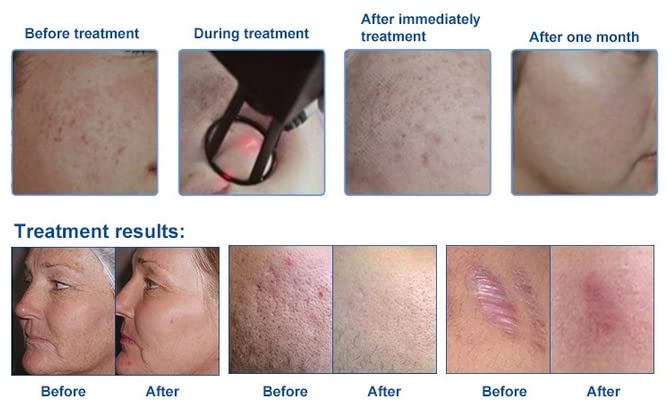 Machine Professionnelle Laser CO2 Fractionnel - Pour Cicatrices, Acné, Rajeunissement