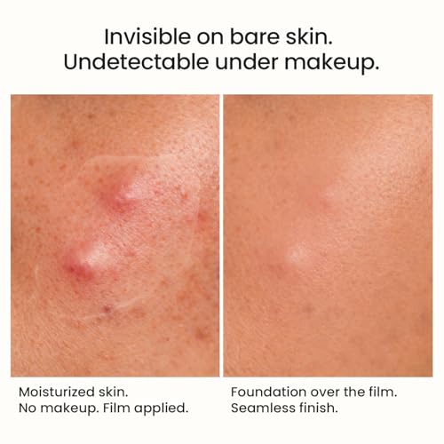 Image of THE SOLVED SKIN Liquid Pimple Patch | Invisible Acne Spot Treatment | MakeUp Friendly | Any Size pimple, Any Location | 300+ Applications | Dermatologist Tested | 10ml