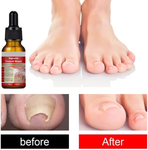 Ingrown Toenail Treatment - Ingrown Toenail - Cuticle Care Oils for Ingrown Toenails - Trimming Toenail Softening Drops Natural Ingrown Toenail Correction Treatment Fungal Nail Treatment - 10ml (1Pcs)