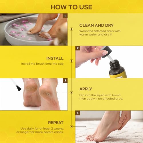 fast-acting bee venom wart remover wart freeze off with salicylic acid amp bee venom cream - wart removal for plantar genital 18 ml