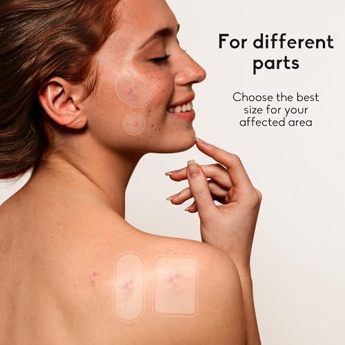 Daolyo Adesivos grandes de espinhas de acne para rosto, 6 tamanhos, 142 unidades, GG, adesivos hidro