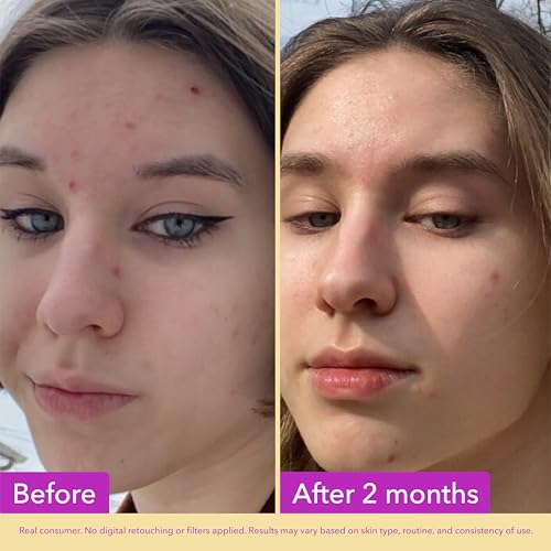 Good Molecules Niacinamide Serum – 10% Niacinamide to Target Blemishes, Nourishment, and Skin Tone – Ultra Hydrating & Brightening Skin Care for Face – 75 ml / 2.53 fl oz - Image 4
