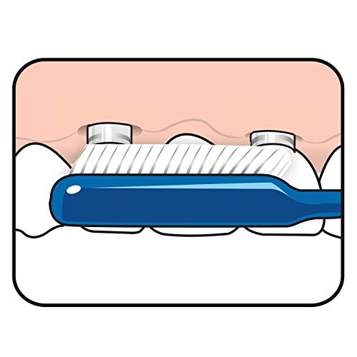 TEPE Spezial-Zahnbürste Implantat Orthodontic mit extra schmalem Bürstenkopf - für Zahnspangen & zur Implantat Reinigung hergestellt / 1 x 1 Stück, Farblich sortiert, 1stk (Packung mit 5) – Bild 8