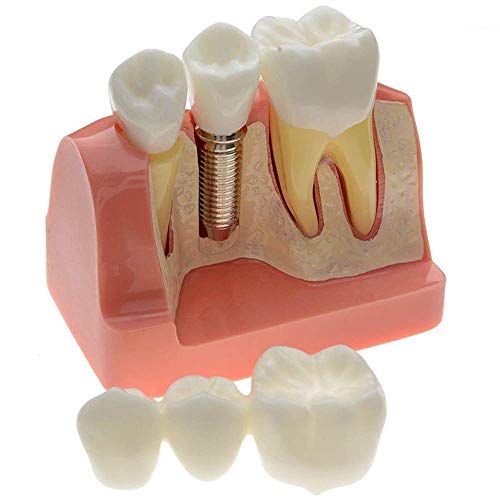 Dentistry Teaching Model Implant Analysis Crown Bridge Demonstration Model Dental Implant Model