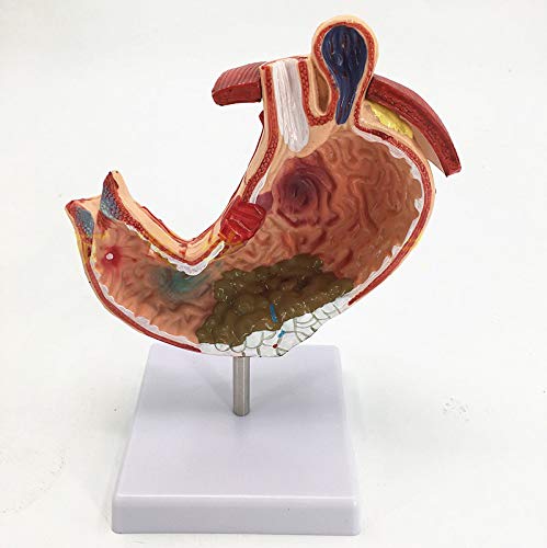 Stomach Anatomy Model, Gastritis Model Gastric Lesion Model, Human Anatomical Anatomy Stomach Medical Model Gastric Pathology Gastritis Ulcer Medical Teaching Learning Tool.