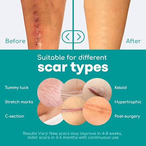 Image of Medi Grade Lerfot Silicone Scar Sheets - 1.6X60 inch For Softening And Flattening Scars, Acne, C-Section, Painless Removal, Reusable, Washable