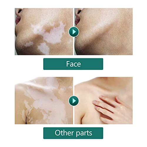Vitiligo Covering Liquid for All Skin Tones, 20ml Men and Women Waterproof Makeup Vitiligo Concealer Cosmetics for Face Body - Image 4