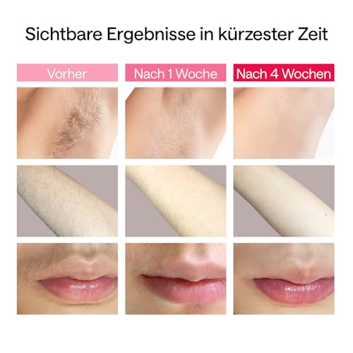 Ulike Air 2 IPL-apparaat voor ontharing voor dames en heren met koelingstechnologie, vrijwel pijnvrije resultaten, veilig alternatief voor laserontharing, voor lichaam en gezicht - Afbeelding 4