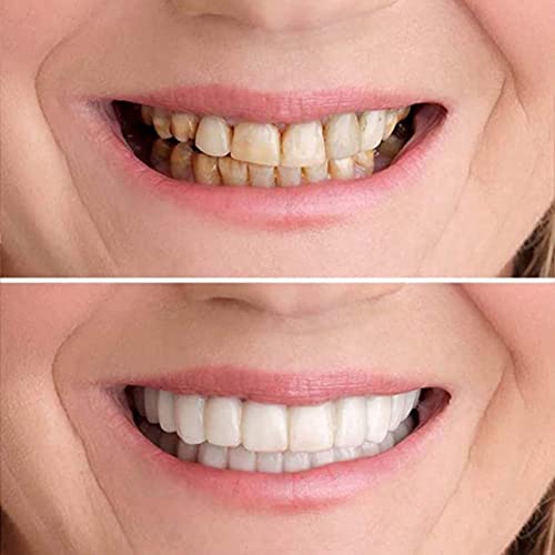 Dentures Teeth Temporary Teeth Perfect Fake Teeth Nature And Comfortable, Protect Your Teeth And Regain Confident Smile (Size : 1) #TOP5