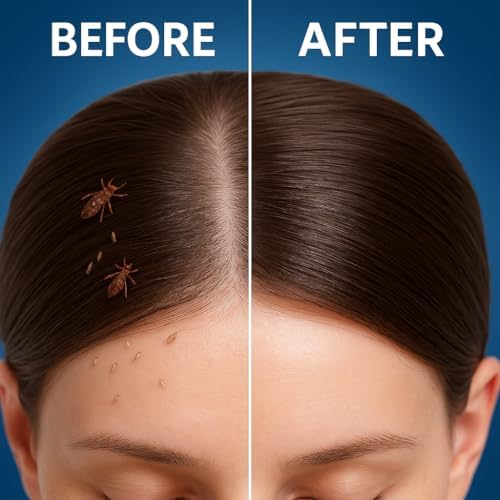 Image of Dr Saune's Lice Removal Comb | Reusable Hair Grooming Tool | Fine Teeth for Scalp Hygiene | Manual Nit & Debris Removal | For Kids & Adults (Lice-comb)
