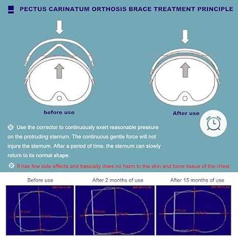 Pectus Carinatum Orthosis Brace, Adjustable Support for Pigeon Chest, Comfortable for Day and Night Wear