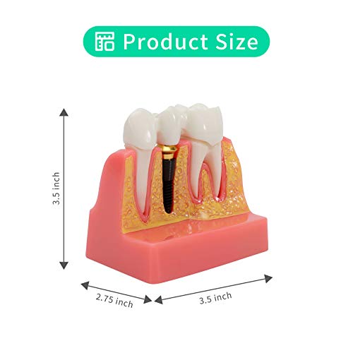 Annhua 4 Times Dental Implant Teeth Model Analysis Crown Bridge Demonstration Model, Dental Teeth Crown Roots Removable For Education, Patients Communication, Learning And Lab #TOP1