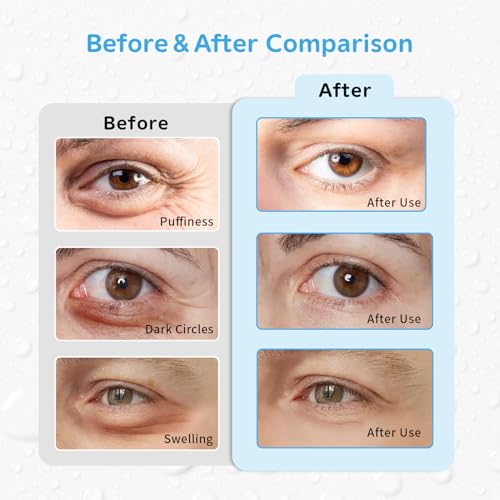 Image of 4PCS Gel Eye Ice Pack Set, Cold & Hot Compress, Reusable Cooling Gel Pads for Strain Relief, Relaxation, SPA and Sleep (4 Blue Flowers-2)