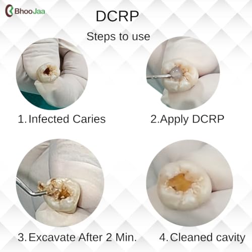 Image of DCRP | Dental Caries Removal Paste for Professional Dental use | Revolutionary Bio-active solution to dissolve soft caries | No Drill, No Pain No anxiety | 3g Pack of 1