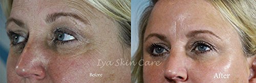 IYA Skin Care Minute Facelift Anti Aging Tightening Serum, 1fl.oz.