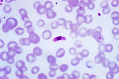 Sickle cell defeated malaria and opened up pastures new
