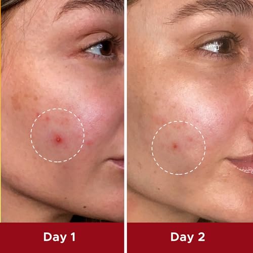 LiBear Pimple Patches, Invisible Acne Cover Patch, Hydrocolloid Acne Patches for Face with Salicylic Acid, Zits Patches for Acne, Bleimish, Pimple Stickers Acne Dots, 96 counts with 10mm, 12mm