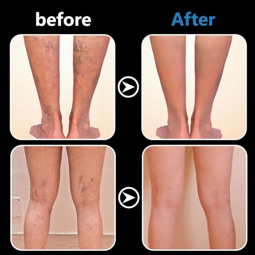 Krampfadern Creme,Varicose Veins Cream,Creme gegen besenreiser, Anti-varicose veins and spider veins cream, Krampfadern und Besenreiser Entfernen,Beine Care Salbe Improve Blood Circulation for Legs20g